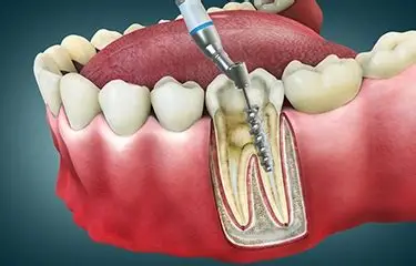 Root Canal Treatment